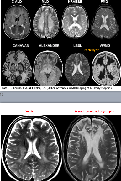 White matter – Brain – bit by bit